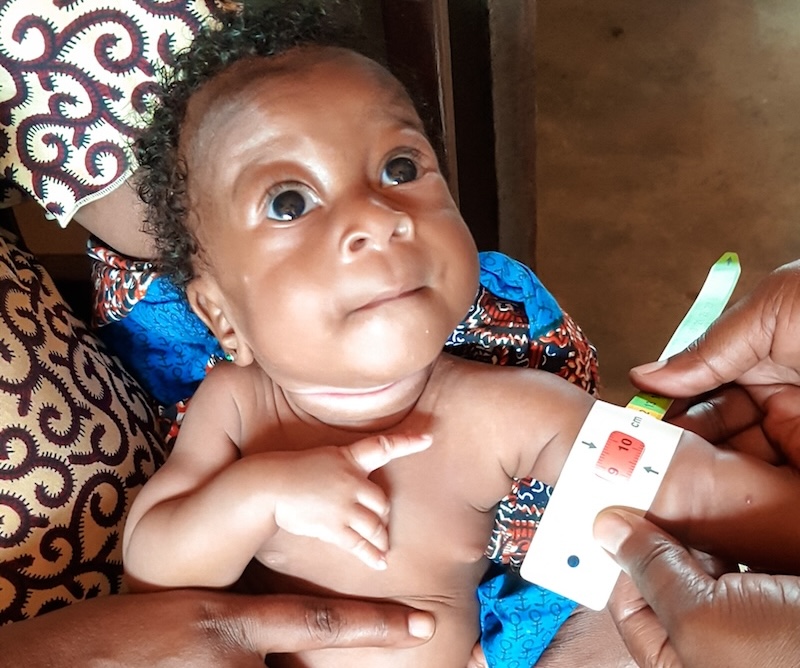 Comment reconnaître la dénutrition chez un enfant